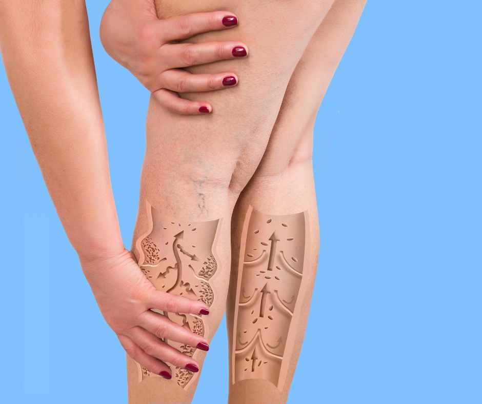 Alimentazione e lipedema guida pratica gambe pesanti
