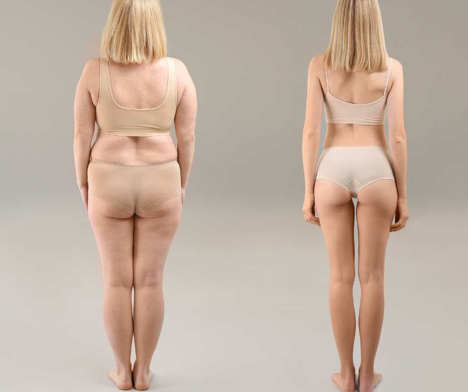 Obesità ginoide e dieta differenze con androide